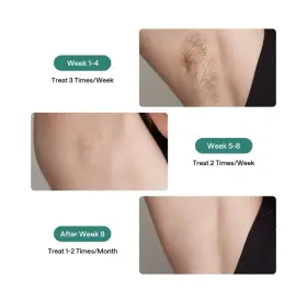 Ui04-dg Ulike - Air 2 Ice Cooling Ipl Dry Hair Removal Device Dark Green #3